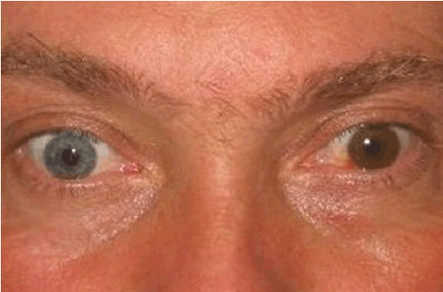Расширенные зрачки не реагирующие на свет. Анизокория карие глаза. Разные зрачки.
